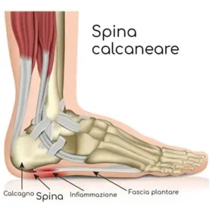 spina calcanea