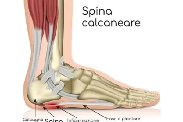 spina calcanea