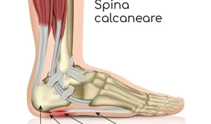 spina calcanea